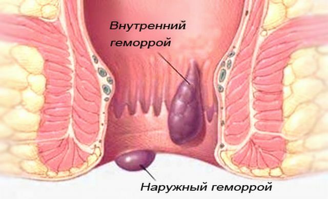 kas yra hemorojus atrodantis moterims