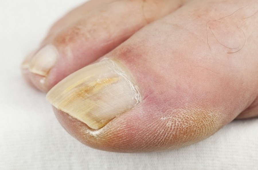 Las uñas en las piernas son gruesas y firmes: ¿cómo suavizar las uñas