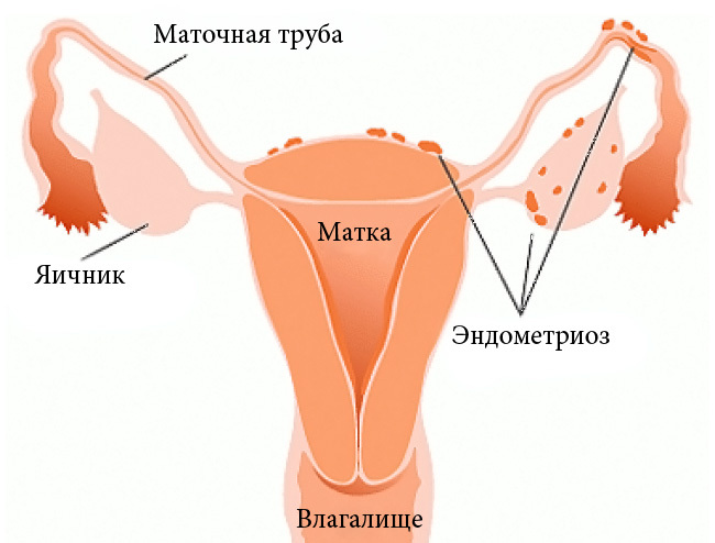 Jeśli między menstruacją pojawia się brązowa wydzielina - czy jest to alarmujący objaw lub norma?