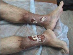 úlcera trófica de la pierna