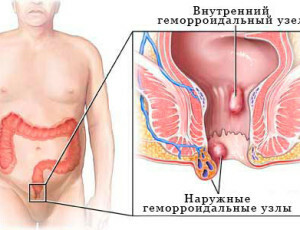 nódulos de hemorróidas