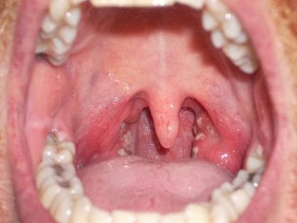 Wat zijn de symptomen van laryngitis bij kinderen, methoden om de ziekte te behandelen