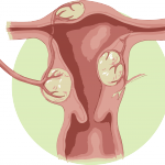 Czy zawsze występuje operacja mięśniaka macicy?