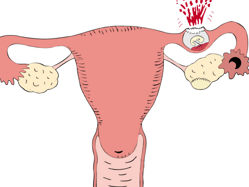 La cause de la nausée chez les femmes. Pourquoi les femmes peuvent-elles avoir de la faiblesse, des étourdissements, des nausées et des vomissements?