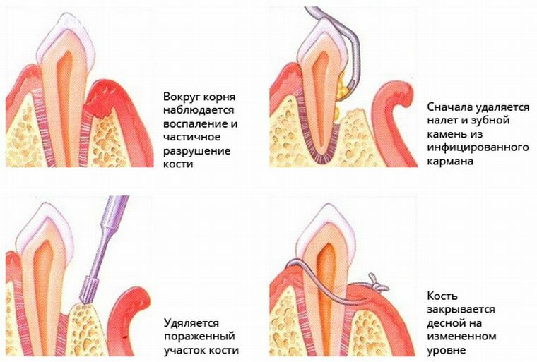 Карман в зубе как выглядит фото