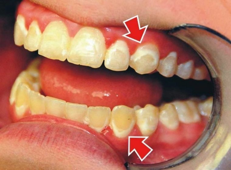 Causas e características do tratamento de cáries nos dentes da frente