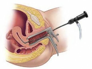 Histerretroscopia do pólipo endometrial