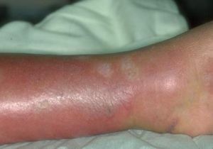 infekčné ochorenie kože