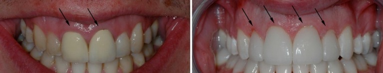 Coroa de cermets: vantagens e desvantagens