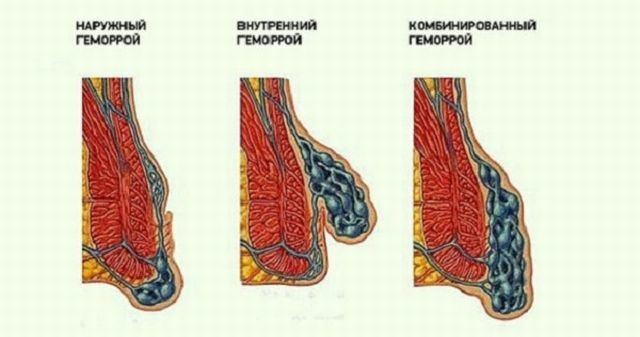 tipos de hemorróidas