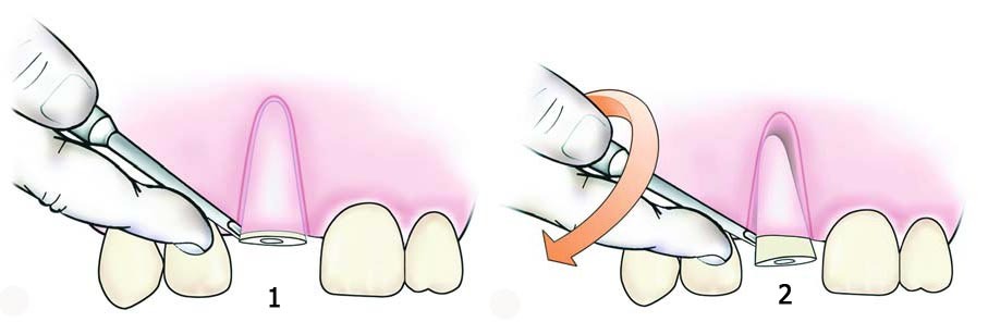 Quais ferramentas são usadas para extração dentária