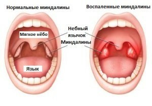 Menstruation with angina