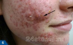 acne papulopustular