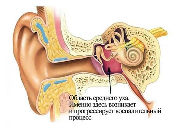 zelfklevende otitis media