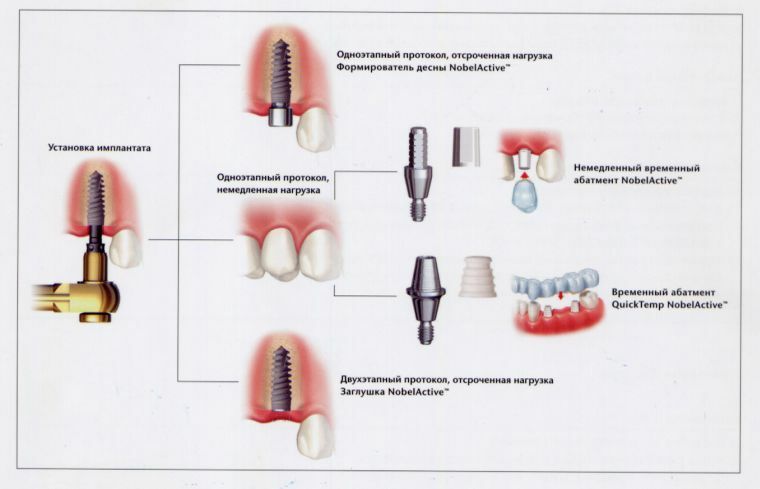 Implantação imediata de dentes: benefícios e indicações