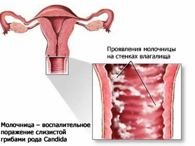 How to use Iodinol for thrush