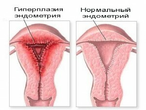 The main causes of endometrial hyperplasia of the uterus