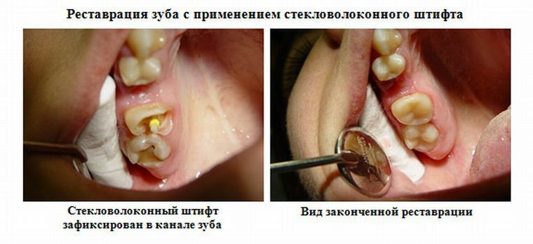 Co to jest szpilka dentystyczna i dlaczego jest stosowana w stomatologii?