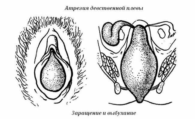 Atresia (infection) of the hymen: diagnosis, treatment