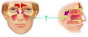 rhinogene sinusitis