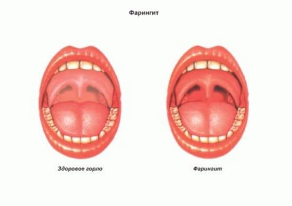 Treatment of pharyngitis with antibiotics: a list of effective drugs