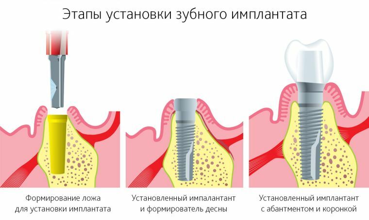 Instalacja implantów stomatologicznych wizualnie etap po etapie