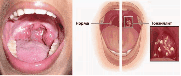 What is decompensated tonsillitis