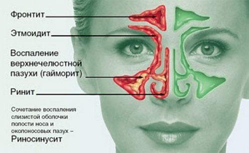 chronic ethmoiditis