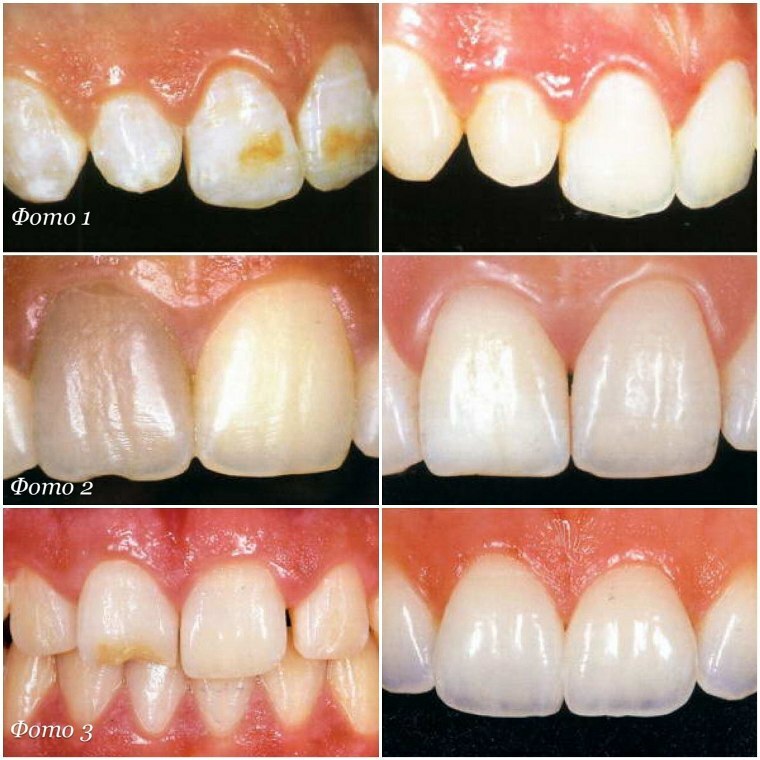 Apa itu veneer, pro dan kontra mereka?