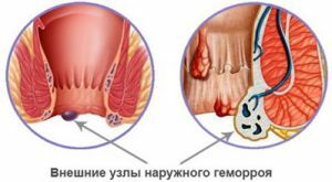 hemorróidas externas
