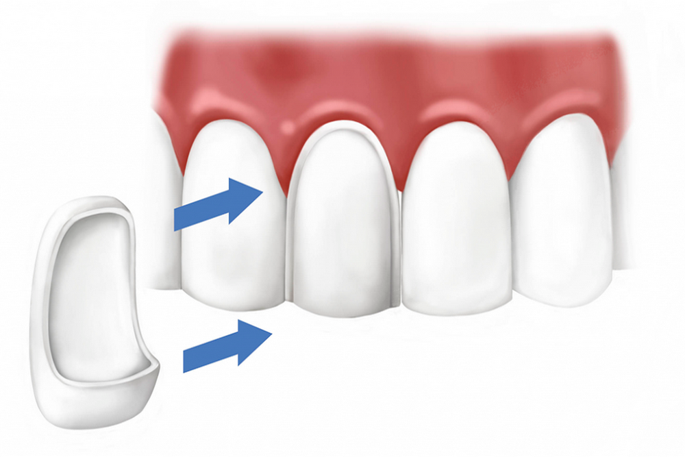 Wat zijn facings? Veneers op de tanden zijn voor- en nadelen. Veneers voor en na