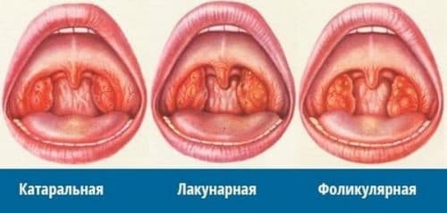 lacunar tonsillit