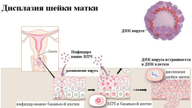 Effective methods for treating dysplasia, their advantages and disadvantages