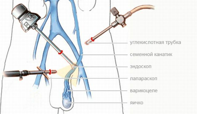 Que tipo de cirurgia é eficaz em varicocele: a escolha de médicos e homens