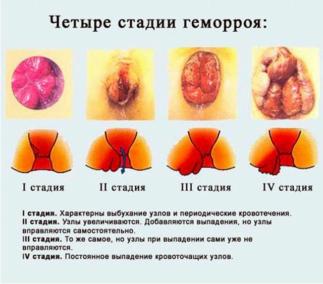 Leczenie hemoroidów w ciąży jest skutecznym rozwiązaniem złożonego problemu