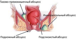 Kodėl vaiko anus pusėje yra įtrūkimai ir kaip su juo elgtis?