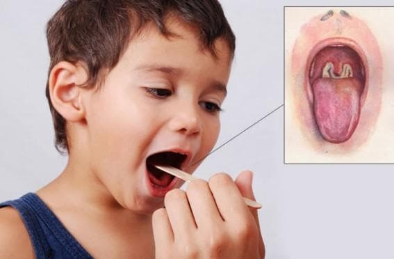Streptococcal throat infection