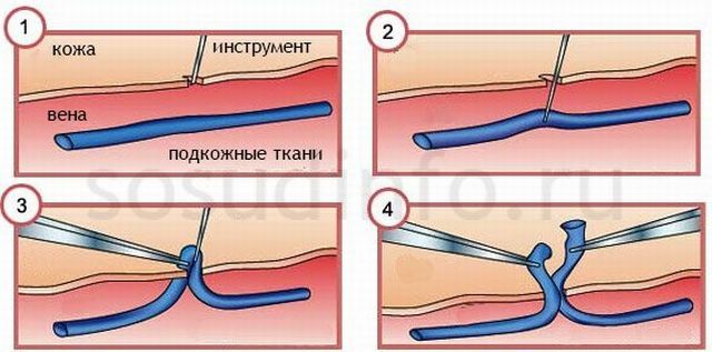 Combined phlebectomy - a modern method of treating varicose veins