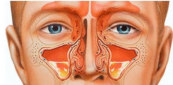 bilateral sinusitis chronic form