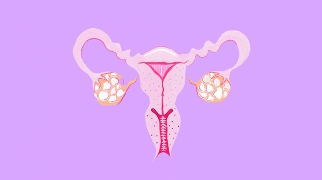 Menorrhagia (hypermenorrhea): what is it in women, how to treat after 50 years, in adolescents, with menopause, ICD-10 code, clinical guidelines