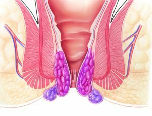 Penyebab, gejala dan pengobatan hemoroid akut