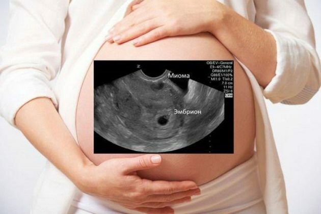 Kan fibromer forveksles med graviditet