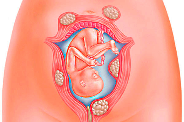 É possível engravidar e dar à luz com miomas uterinos