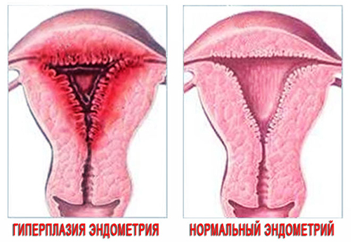 Mungkinkah untuk menyembuhkan hiperplasia endometrium tanpa gesekan 1