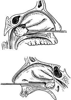 electrocautery at front