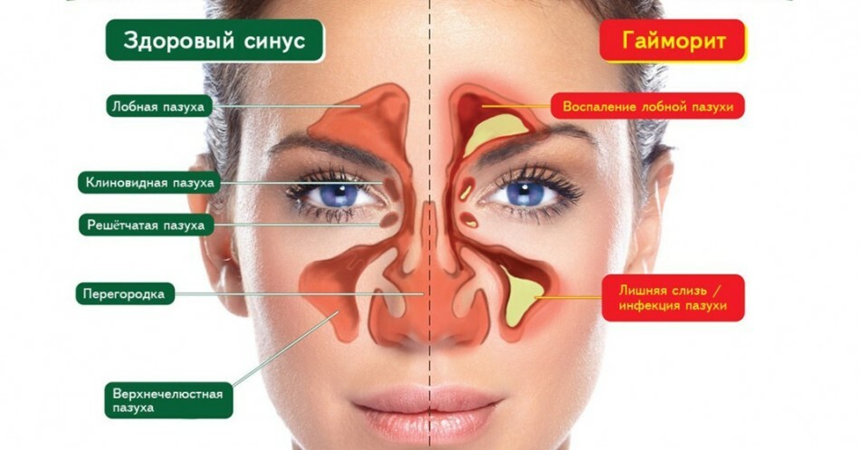 Sinusitis in children symptoms and treatment. Residual phenomena after sinusitis. How to treat sinusitis in children at home?