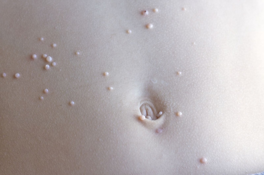 Molluscum contagiosum bij kinderen. Symptomen, oorzaken en behandeling van molluscum contagiosum bij kinderen. Verwijdering van molluscum contagiosum bij kinderen