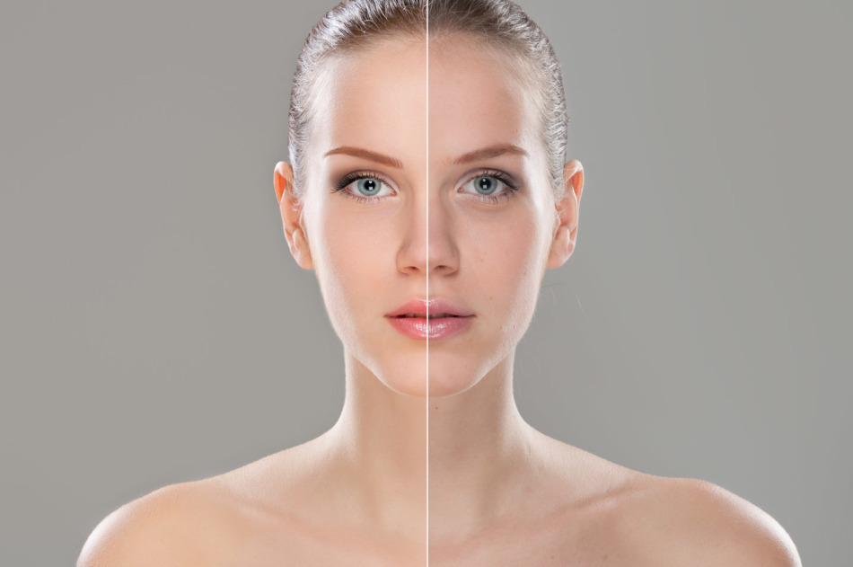 Beauty injections. Biorevitalization with hyaluronic acid