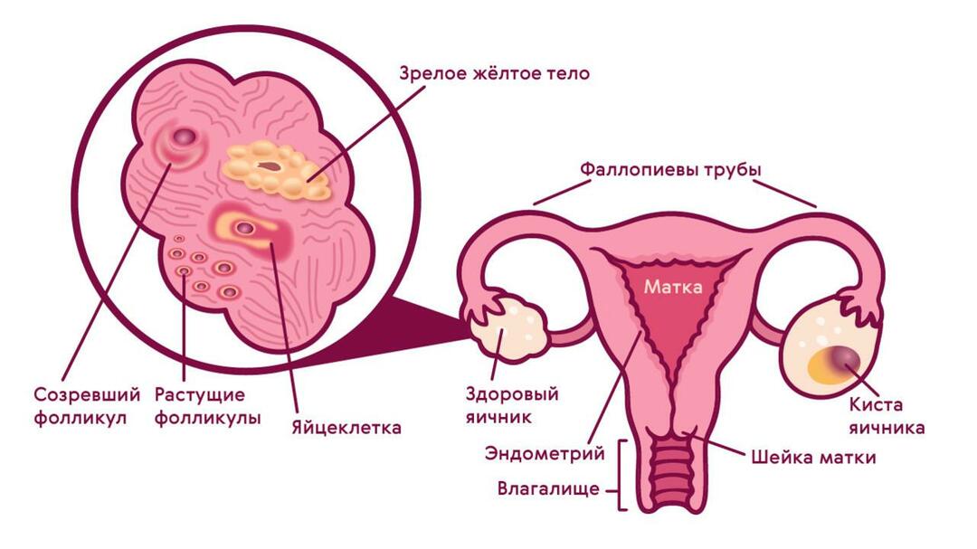 Cyste van het corpus luteum van de eierstok (symptomen, behandeling, prognose)