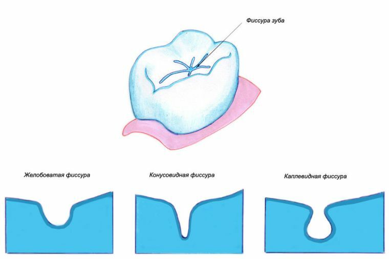 Karies fissure: penyebab, stadium diagnosis dan pengobatan